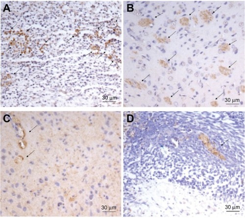 Figure 7 The representative micrographs of the immunohistochemical detection of CD31+ microvessels. The representative micrographs of the immunohistochemical detection of CD31+ microvessels in C6 brain tumor-bearing rats in (A) the control group, (B) the DCA treatment group at 25 mg/kg, (C) the DCA treatment group at 75 mg/kg, and (D) the DCA treatment group at 125 mg/kg.