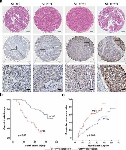 Figure 6. The expression of GIT1 and its prognosis value in 158 HCC patients