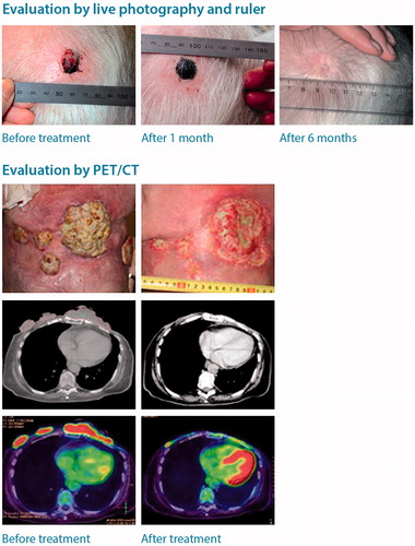 Figure 2. Patients referred for electrochemotherapy present with different clinical stages of cutaneous metastasis. Evaluation of smaller tumours may favourably be performed using digital photography and ruler (top panel, from [Citation36]). For larger tumours, imaging such as PET/CT can be very valuable in determining response (bottom panel, from [Citation9]).