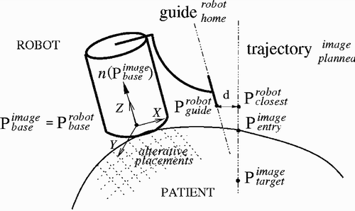 Figure 3. Preoperative robot placement computation.