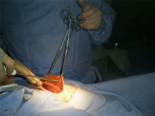 Figure 2 The PlasmaJet® handpiece spraying neutral argon plasma to seal lymphatics following groin dissection.