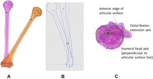 Figure 2 In three-dimensional measurements of cubitus varus, the anteroposterior view of the varus deformity angle (A) was obtained by measuring the angle between the humeral axes of the affected and normal humeri. Lateral view of the extension deformity angle (B). The internal rotation deformity angle was measured as the difference in retroversion angles (θ) of the affected and normal humeri (C).
