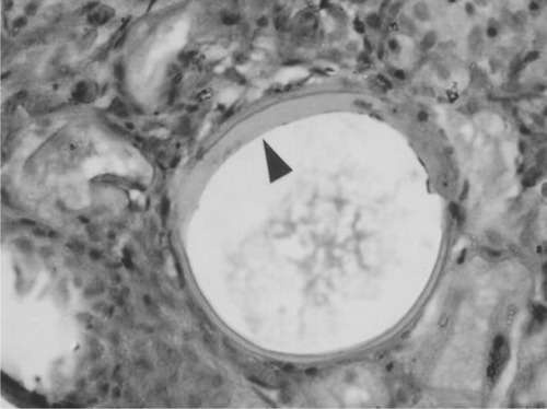 Figure 4 An empty rhinosporidial sporangium with abnormally thickened walls (arrow), containing amorphous eosinophilic material; rhinosporidial endospores are not seen. Initial magnification × 400. H&E.