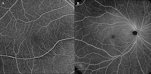 Figure 1 (A) The 6mm × 6mm Angio en face OCT-A image centered on fovea. (B) The 15mm × 15mm Montage en face OCT-A whole retina image.