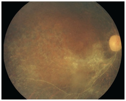 Figure 2 After treatment, development of retinal pigment epithelial changes and reduction of retinal hemorrhage were observed in the right eye.