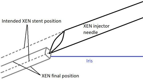 Figure 9 The XEN stent will reach a more posterior final position than the injector needle, since the stent will center around the point where the tip of the needle first penetrates the anterior chamber angle structures.