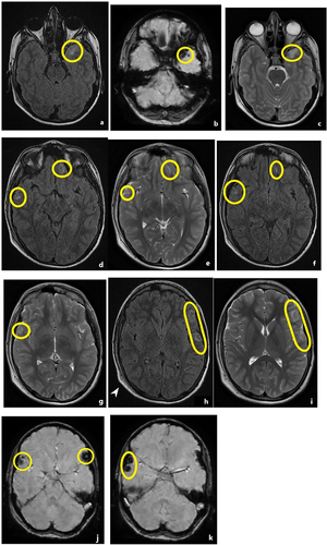 Figure 1 Right occipital epicranial hematoma (white pointed arrow h). All images show case bilateral cortical contusions on different MR sequences. (a, d, f, h) FLAIR sequences depicting hyperintense signal areas consistent with CCs (yellow circles and capsule). (b, j, k) SWI sequences display the same lesions with hypointense signal (yellow circles and capsule). (c, e, g, i) CCs with hyperintense T2 signal (yellow circles and capsule). (d, e, f) Left frontal non-hemorrhagic traumatic axonal injury (yellow circles and capsule). (d, e) FLAIR sequences; (f) T2-weighted sequences. (h-i) The epicranial hematoma located in the right occipital area pinpoints the force impact; high-signal FLAIR and T2 lesions support the “contrecoup lesions” diagnosis (yellow capsule).