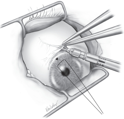 Figure 1 Triamcinolone acetonide is injected using a blunt cannula prior to conjunctival closure. The cannula is inserted in the hub and the steroid depot is injected in the retrobulbar space.