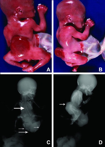 Figure 1.  (A) Posterior view of Patient 1 showing fetus with sacrolumbar myelomeningocele, and contracted lower extremities. (B) Lateral fetal view depicts the attached amnion covering omphalocele with a short umbilical cord wrapped around the amnion covering the abdominal wall defect. The fetus also has bilateral flexion contracture deformity of lower extremities. (C) Post-mortem antero-posterior x-ray showing segmentation anomalies of the thoracic vertebrae (thick arrow), omphalocele (thin arrow) and meconium peritonitis (small thin arrows). (D) Post-mortem lateral x-ray showing lumbosacral myelomeningocele (arrow).