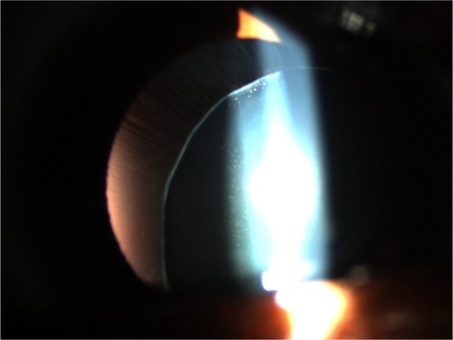 Figure 2 Inferonasal lens dislocation and stretched zonula of patient number 2.