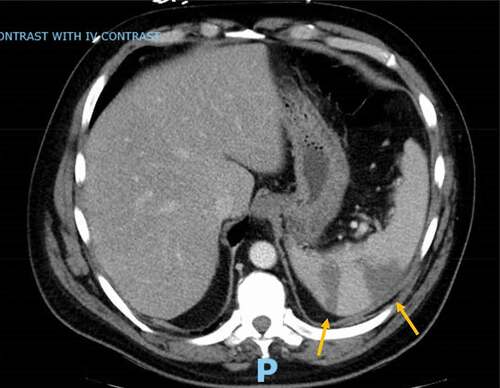 Figure 2. Computer tomography abdomen revealing wedge-shaped defects of the spleen consistent with infarcts