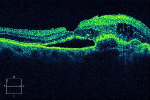 Figure 11 This Cirrus™ optical coherence tomography section demonstrates an elevation of the macular region with loss of the foveal depression.