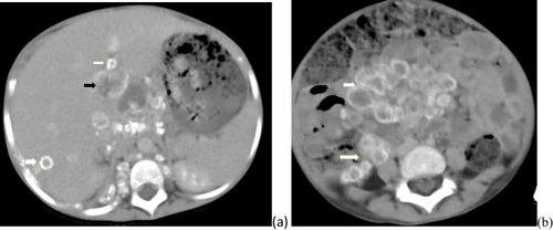 Figure 3 Post contrast abdominal Ct scan (a) Ct image at hepatic level, showing different size multiple central hypo enhancing lesion smaller ones having peripheral calcification (white arrow) and centrally located larger lesions with irregular rim enhancement (black arrow) (b) Ct image at L4/5 level multiple peripherally calcified lymphadenopathies (white arrow).
