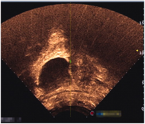 Figure 5. The blood flow of pregnancy tissue examined by transabdominal colour Doppler scanning contrast medium revealed perfusion in the pregnancy tissue before HIFU ablation.