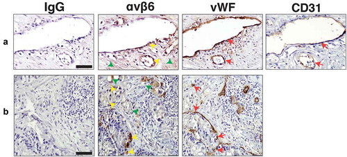 Figure 8. Expression of αvβ6 integrin, vWF and CD31 in blood vessels of human prostate cancer tissues.