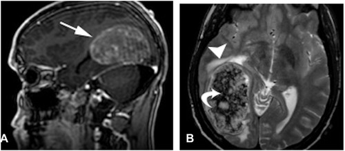 Figure 10 Brain metastases of NSGCT with a patient presenting with headaches. (A) Sagittal T1-weighted postcontrast images showing intra-axial heterogeneous enhancing mass lesion in right occipital region. (B) Axial T2WI Large intra-axial heterogeneous mass lesion with surrounding mass effect and edema, also showing internal darkT2 foci, which could represent hemorrhagic components.