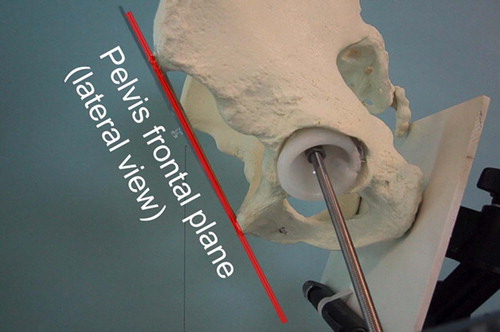 Figure 3. Visualized frontal plane of the pelvis.