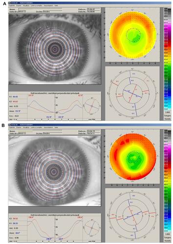 Figure 4 Right eye videokeratography maps of 64 yrs old female patient, before (A) and after (B) enhancement 3 years post-PRK using topographically guided customized excimer laser photoablation with CIPTA platform. The topographic values highlight the improved corneal profile obtained. Prior to transepithelial photoablation her DCVA (−2sph=−1 cyl (30°) was 20/25. After the procedure her DCVA was 20/20 with −0.50sph.