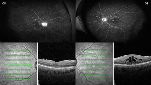 Figure 1 Topical corticosteroid drops OU and previous intravitreal triamcinolone OS, widefield fluorescein angiography (Optos) and optical coherence tomography. Bright green line indicates section of image provided and green arrow has no significance.