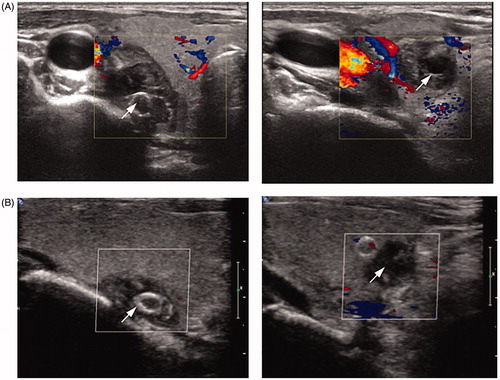 Figure 3. Ultrasound characteristics of the patient in Figure 2 after microwave ablation (MWA). Images of the upper and lower nodules on the right side and the blood flow by color Doppler flow imaging at 1-month (A) and 36-month (B) follow-up.