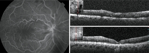 Figure 2 Fluorescein angiography (35.1 seconds) of another patient with recent onset central retinal vein occlusion in the right eye revealing ischemia in the macular area (left). Gray-scale spectral domain optical coherence tomography (SD-OCT) vertical scan at the initial visit (upper right) demonstrates the presence of a discrete amount of subretinal fluid under the fovea and loss of inner retinal layers. Visual acuity was counting fingers at this point. This patient was treated with an intravitreal injection of bevacizumab and panretinal photocoagulation. Gray-scale SD-OCT vertical scan at the final visit (lower right) shows resolution of subretinal fluid under the fovea. The inner segment/outer segment (IS/OS) cannot be identified in the fovea and there is loss of the normal inner retina architecture. Visual acuity was 20/400 at final visit.