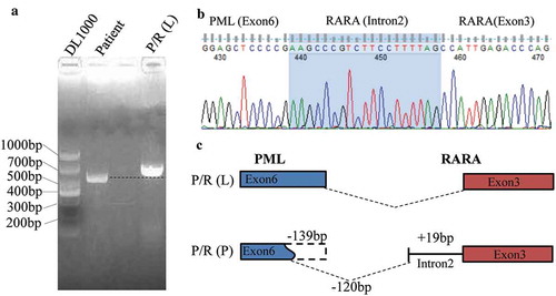 Figure 2. Detection of the PML-RARα using the semi-quantitative PCR and DNA sequencing method. (A) Agarose gel electrophoresis showed a specific slightly smaller band in the patient compared with L-type PML-RARα. (B) DNA sequencing analysis of PCR product. (C) The schema chart of the new PML-RARα transcript.
