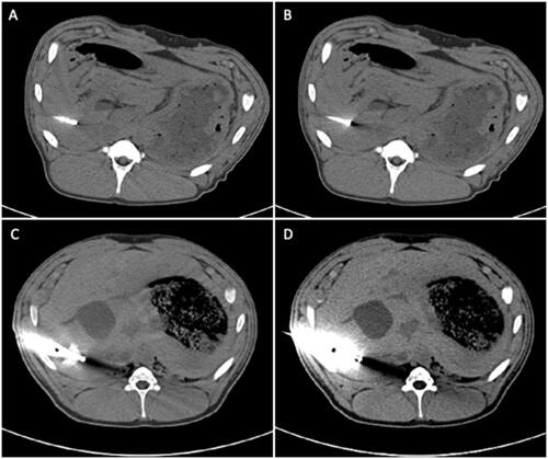 Figure 2. Examples of different artifact extents for qualitative evaluation of the liver parenchyma at probe tip; 1- marginal artifacts, 2-minor dark streaks < 2 cm, 3- distinct dark streaks > 2cm, 4- extensive artifacts hampering further puncture pathway planning.