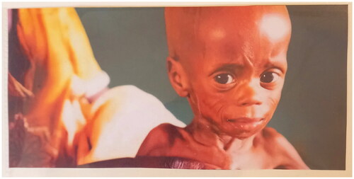 Figure 3. A malnourished child.