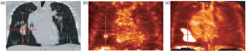 Figure 2. Non-linear registration without tumor-based constraints. (a) A slice of the original CT image. (b) The corresponding slice in the PET image. (c) The registered PET. The absence of constraints on the tumor deformation leads to undesired and irrelevant deformations of the pathology. In (a), the cursor is positioned on the tumor localization in the CT data, and in (b) and (c) the cursor points to the same coordinates. This example shows an erroneous positioning of the tumor and illustrates the importance of tumor segmentation and the use of tumor-specific constraints during the registration in (c). [Color version available online.]