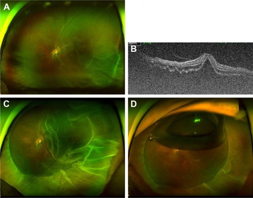 Figure 6 A case of RRD with fluidic vitreous humor without PVD. A 12-year-old girl presented with visual loss for 3 days.