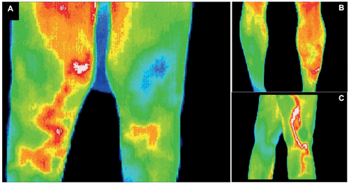 Figure 3 Thermogram of the lower extremities: deep vein thrombosis.