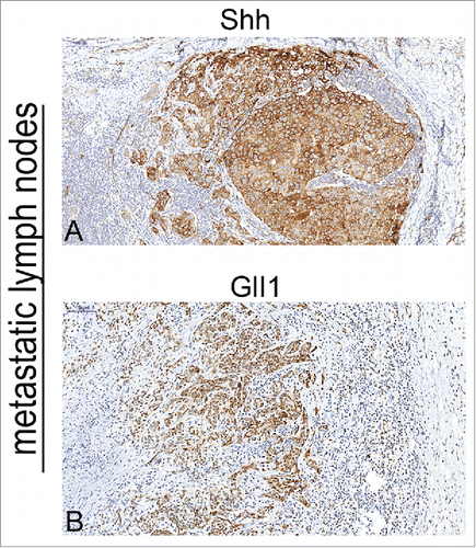 Figure 2. Immunohistochemical detection of Shh, Gli-1 in metastatic lymphnodes of OSCC specimens. A, cytoplasm of expression of metastatic lymphnodes for Shh (strong staining); B, nuclear and cytoplasm expression of metastatic lymphnodes for Gli1 (strong staining). Bars indicate 100 um.