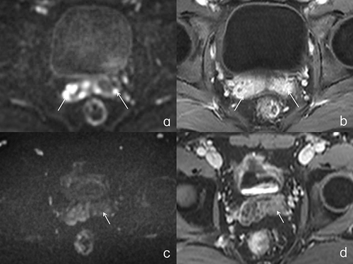 Figure 2 (a and b) show the same patient. (a) shows irregular high signal shadows (white arrows) in the bilateral seminal vesicles at the transverse section of the pelvic DWI (B=800), with ADC showing low signal, indicating limited diffusion; (b) Significant enhancement of bilateral seminal vesicles (white arrow) can be seen in the transverse section of T1WI fat-suppressed sequence enhanced scan of the pelvic cavity; (c and d) shows the same patient. In (c), the transverse section of the pelvic DWI (B=800) shows a narrowing of the left seminal vesicle gland, with a low signal (white arrow) on the left seminal vesicle gland, indicating unrestricted diffusion; (d) Pelvic T1WI fat-suppressed sequence enhanced scan transverse section shows mild enhancement of the left seminal vesicle gland (white arrow).