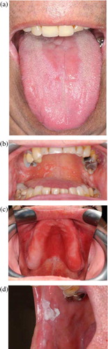 Fig. 1.  Clinically distinct forms of primary oral candidosis. (a) Acute erythematous candidosis; (b) pseudomembranous candidosis; (c) chronic erythematous candidosis; (d) chronic hyperplastic candidosis.