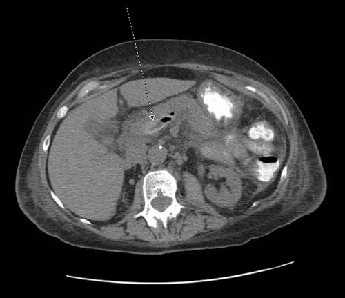 Figure 1. Computerized tomography of the abdomen showing hyperdensity (clot) in the portal vein.