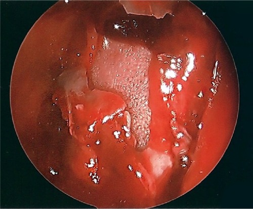 Figure 3 Endoscopic view of the orbital floor from the maxillary sinus.