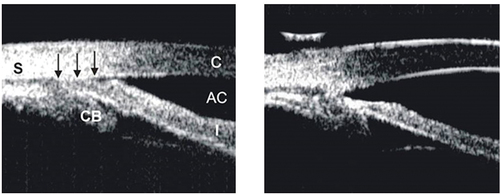 Figure 1. Ultrasound biomicroscopic (UBM) images illustrating how ALPI compacts the peripheral iris stroma, creating a space between the anterior iris surface and the trabecular meshwork, thus opening the angle. Left: appositionally closed angle in an eye with plateau iris syndrome (S: sclera, CB: ciliary body, AC: anterior chamber, C: cornea). Right: open angle after ALPI.