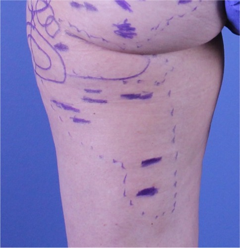 Figure 1 Cellulite depressions of the buttocks and posterior and lateral thighs marked with a surgical blue marker prior to subcision.
