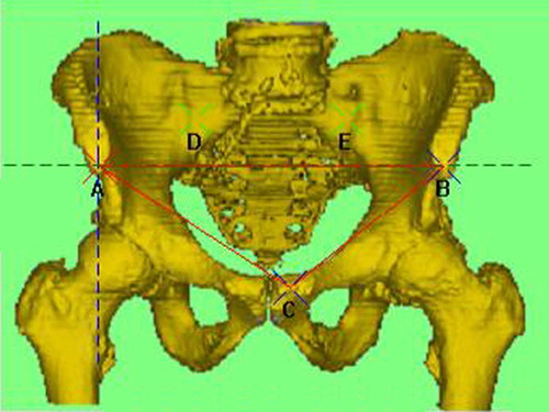 Figure 1. Anteroposterior view showing the anterior pelvic plane (plane ABC or APPCor, shown in green); planes APPSag and APPAx are represented by the blue and green dashed lines respectively.