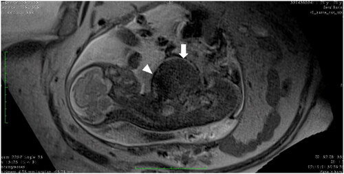 Figure 6. Fetal magnetic resonance imaging of the #Case 6 at 28 weeks of gestation showing the ectopia cordis (head arrow) and omphalocele (arrow).