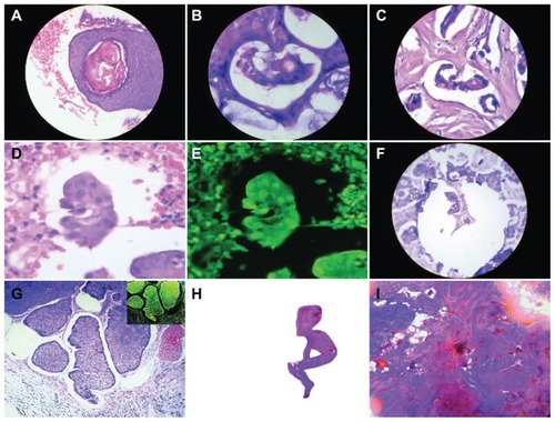 Figure 4 Embryoid structures are located in amniotic-cavity-like domains. (A) Skin squamous cell carcinoma, hematoxylin and eosin staining (20×). (B) Colon adenocarcinoma, hematoxylin and eosin staining (40×). (C) Breast adenocarcinoma, hematoxylin and eosin staining (40×). (D and E) Skin basal cell carcinoma, hematoxylin and eosin staining (40×). (F) Gastric adenocarcinoma hematoxylin and eosin staining (20×). (G) Skin basal cell carcinoma, hematoxylin and eosin staining (40×). (H) Detachment subimage of (I) Image of well-developed embryoid body in a case of endometrial adenocarcinoma, hematoxylin and eosin staining (20×).
