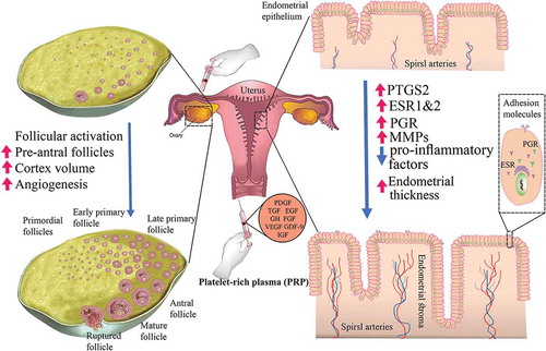 Figure 1. The putative role of platelet-rich plasma (PRP) on endometrial receptivity and ovarian function. ‎Intraperitoneal infusion of PRP may support ovarian tissue regeneration and reactivation via 1) activation of dormant follicles, 2) increase in cortex volume, and 3) induction of neoangiogenesis in the dysfunctional ovarian tissue. Intrauterine administration of PRP may pave the way for embryo implantation via 1) upregulation of COX2, a converter of arachidonic acid to prostaglandins, 2) increase expression of ER and PR which are involved in endometrium response to ovarian hormones and endometrium thickness, 3) enhancement of MMPs expression and so regulation of the tissue remodeling, and 4) reduction of pro-inflammatory factors in abnormal conditions such as endometritis. COX2: cyclooxygenase-2; EGF: epidermal growth factor; ER: estrogen receptors; FGF: fibroblast growth factors; GDF-9: growth differentiation factor 9; GH: growth hormone; IGF: insulin-like growth factor; MMPs: matrix metalloproteinases; PR: progesterone receptor; PDGF: platelet-derived growth factor; TGF: transforming growth factor; VGEF: vascular endothelial growth factor