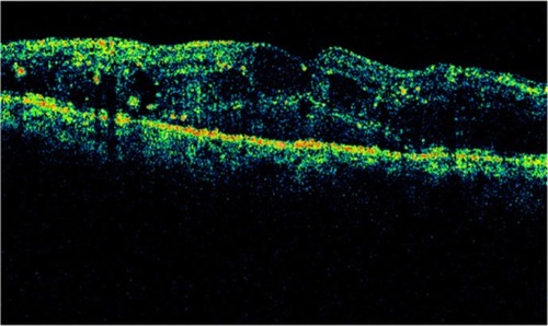 Figure 24 Stratus optical coherence tomography image.