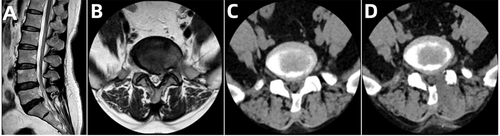 Figure 3 Pre- and postoperative CT and MRI of UBE. (A–C) Preoperative CT and MRI showing LRS. (D) Postoperative CT showing lateral recess enlargement.