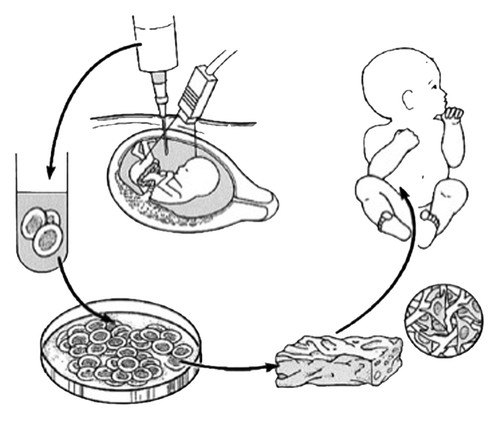 Figure 1. Schematic diagram of tissue engineering from amniotic fluid-derived stem cells for the treatment of congenital anomalies. Autologous fetal stem cells are obtained by amniocentesis. The cells are expanded ex vivo in parallel with the remainder of gestation and subsequently placed on biodegradable scaffolds prior to implantation at birth. Reprinted with permission.Citation5