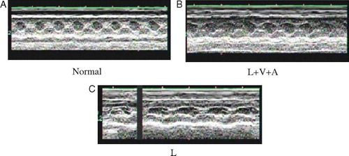 Figure 2.  A,B & C. M-mode echocardiography (Philips Company, SONOS-5500) was used to evaluate the cardiac function of L + V+A and L groups at the day before surgery (normal, Figure 2A) and the first week (L + V+A, Figure 2B; L, Figure 2C). Two-dimensionally guided M-mode recordings were obtained from the short axis view at the level of the chordae tendineae to inspect left ventricle systolic function using a 5-12MHZ S-12 probe.