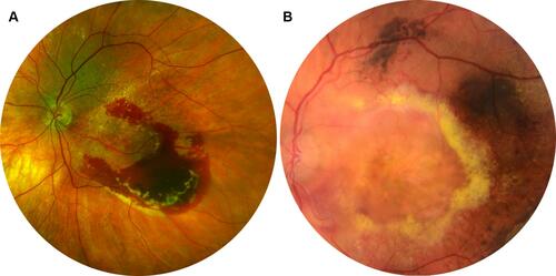 Figure 1 Partial displacement was defined as the absence of haemorrhage under the foveola but with persisting traces of blood within 1500 μm centred on the fovea (A); complete displacement was defined as the absence of subretinal blood within 1500 μm centred on the fovea (B).