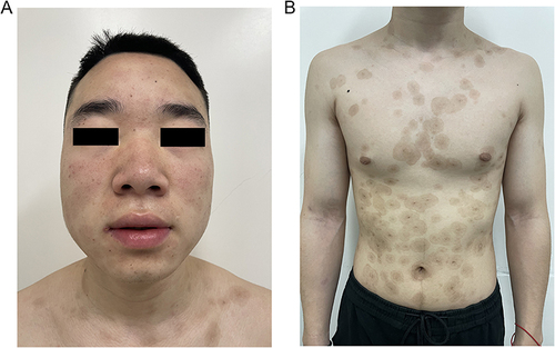 Figure 3 The skin lesions on the patient’s face (A), trunk, and limbs (B) have improved significantly after 18 weeks of treatment.