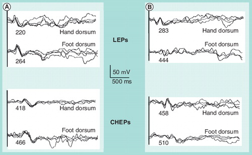 Figure 3. Nociceptive-evoked potentials (laser-evoked potentials and contact heat-evoked potentials) to stimuli to both hands and feet.(A) In a healthy subject and (B) in a patient with axonal distal polyneuropathy. Numbers below each waveform express the peak latency in miliseconds.CHEP: Contact heat-evoked potential; LEP: Laser-evoked potential.