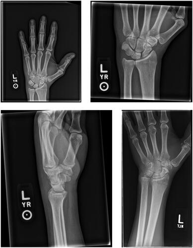Figure 2. X-rays of the left hand and wrist at 2.5 year follow-up showing resolution of the subcutaneous air with no obvious sequelae. A new unrelated scaphoid fracture is noted.